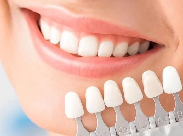 10 Common Questions About Dental Veneers Answered