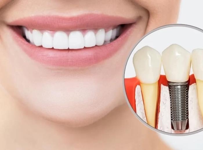 8 Facts You Should Know Before Getting Dental Implants
